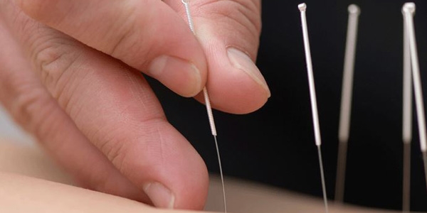 Kuru İğne Tedavisi Nedir ? Kimlere Uygulanır ?