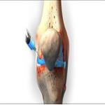 İntraartiküler Hyaluronik Asit Enjeksiyonu