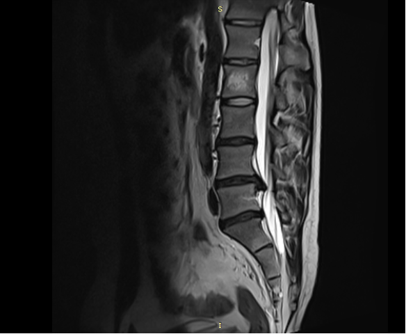 Bel Fıtığı Tedavisi