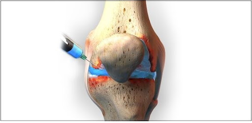 İntraartiküler Hyaluronik Asit Enjeksiyonu
