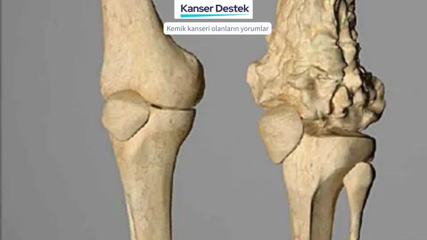Kemik Kanseri